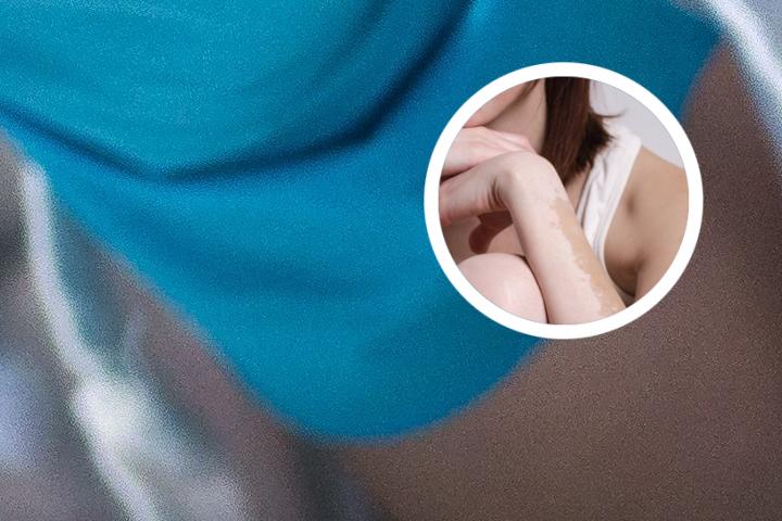 白癜风病多大容易得病