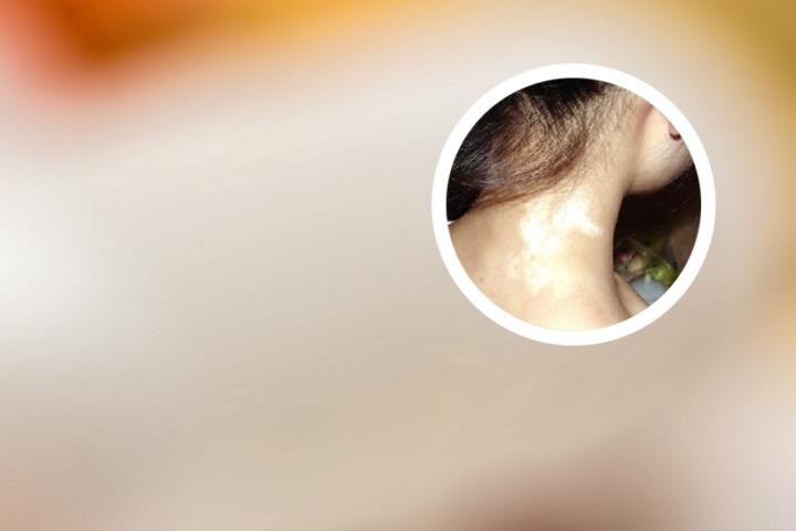 白白癜风怎么治