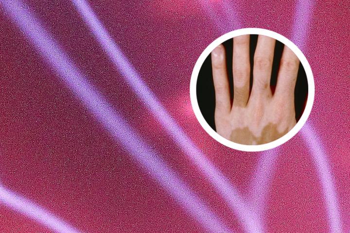 白癜风查出高血压高血脂