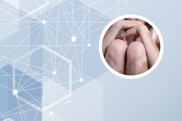 白癜风患者能吃生蚝吗