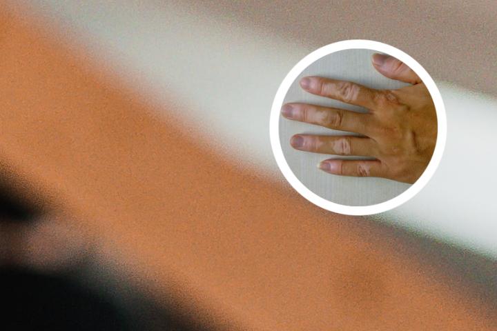 苏州中医院白癜风科