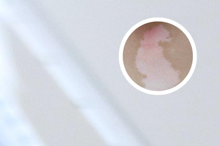白癜风身体光疗照多久