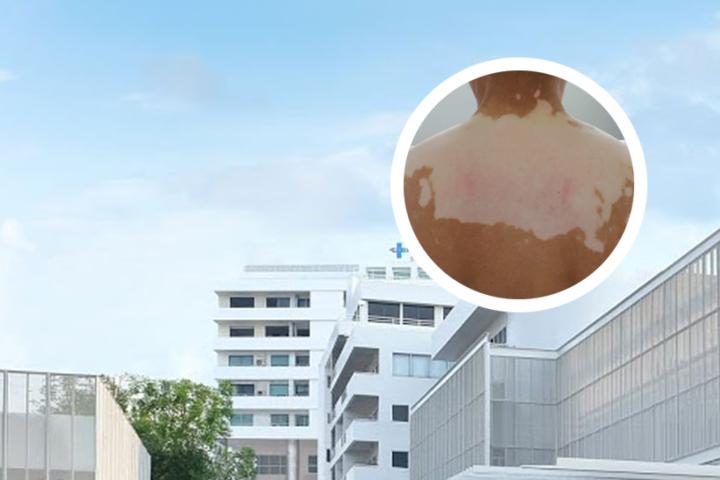 白癜风能快速治好吗