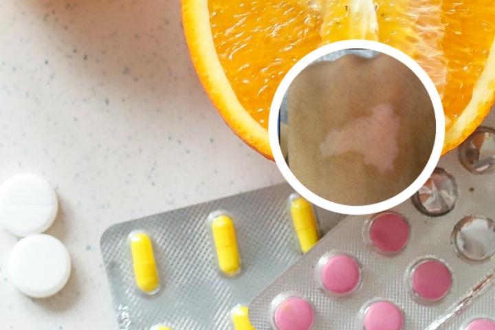 女性白癜风护理常识