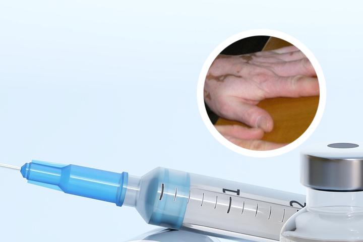 白癜风眉毛白了很难医治吗