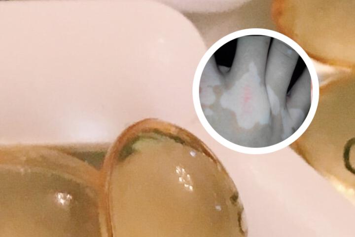 白癜风好了能吃南瓜吗