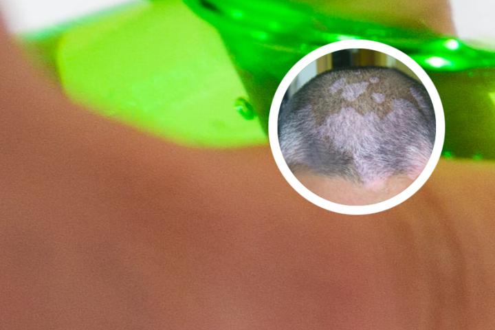 白癜风开始痒不痒