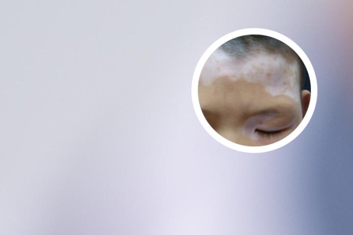 白癜风苹果可以吃吗