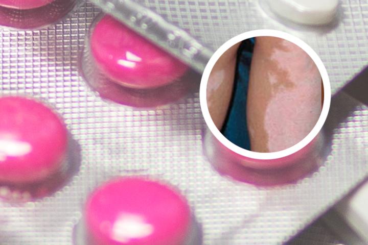 白癜风5种食物禁忌