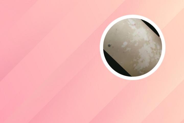 白癜风最新治疗法