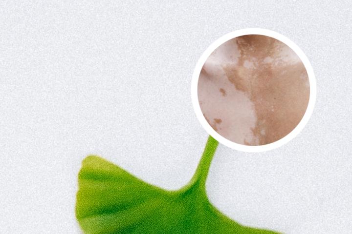 白癜风十年算不算早期
