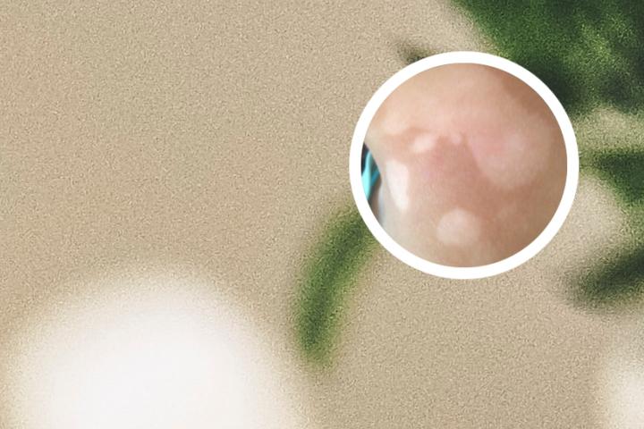 白癜风吃强的松片用法用量