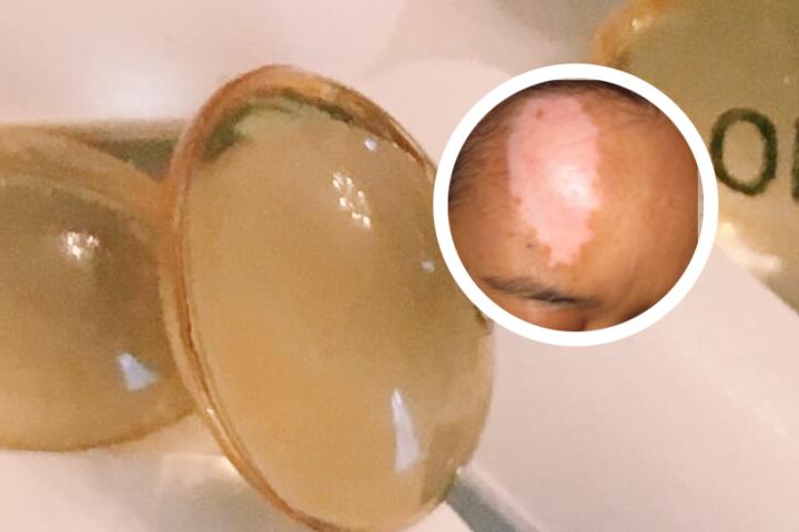 白癜风人可以喝鲜牛奶吗