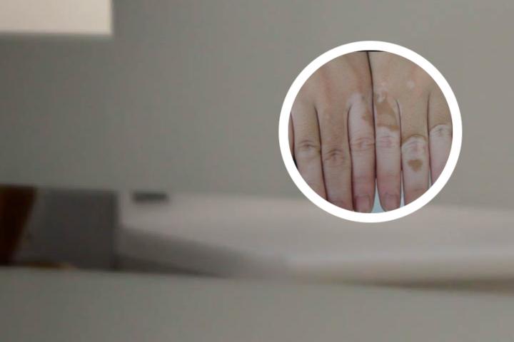 白癜风前期需要怎么治疗