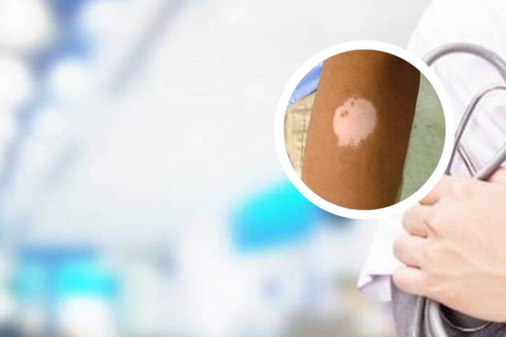 白癜风目前医保能报销吗