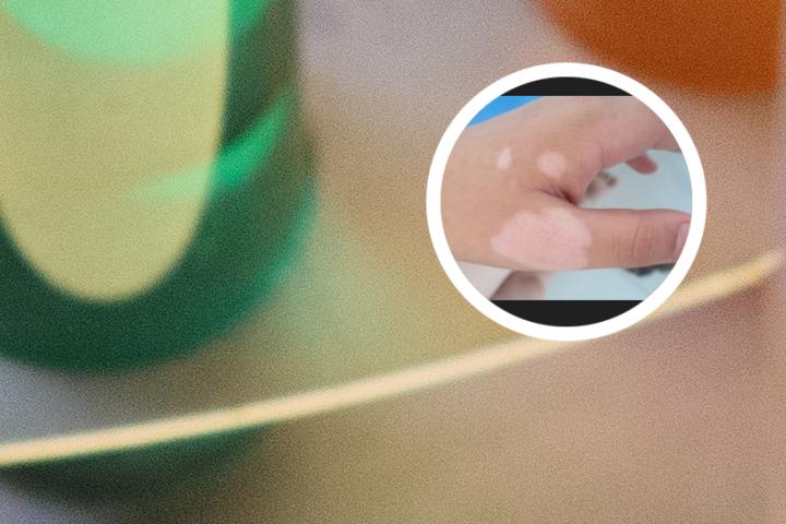 白癜风病早期症状怎么化验