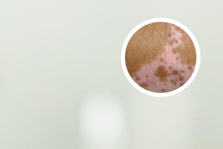 白癜风还能看见血管吗