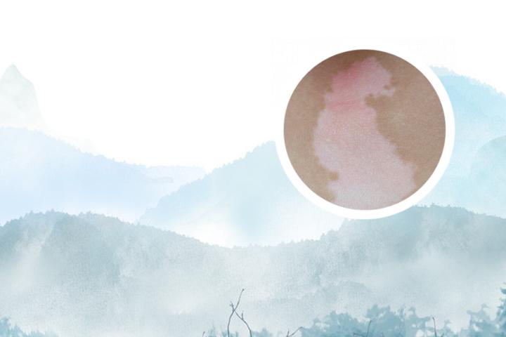 白癜风初期也怕阳光吗