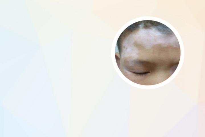 白癜风网上在线咨询