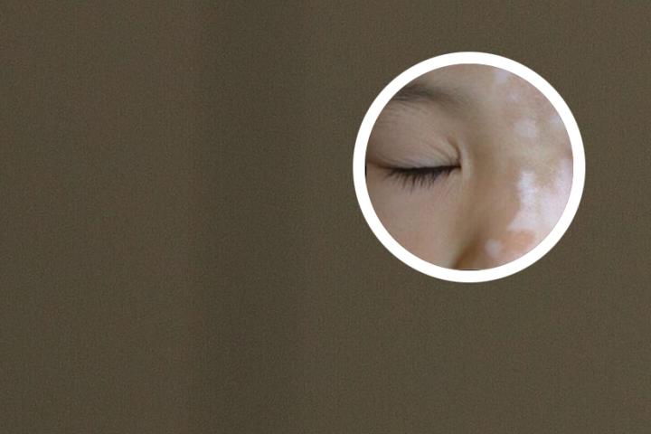 白癜风十几年不扩散的原因