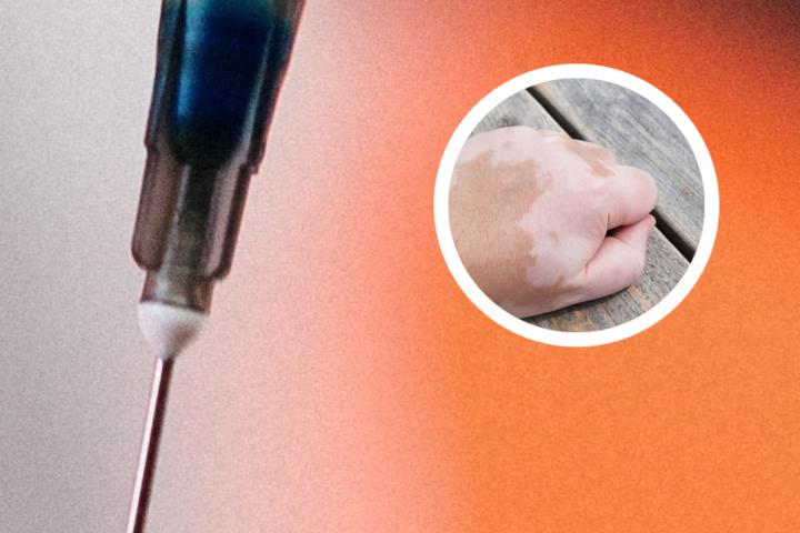白癜风人能用桑叶泡水喝吗