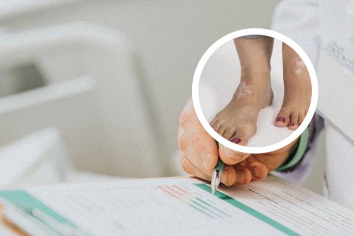 白癜风的科学治疗方法