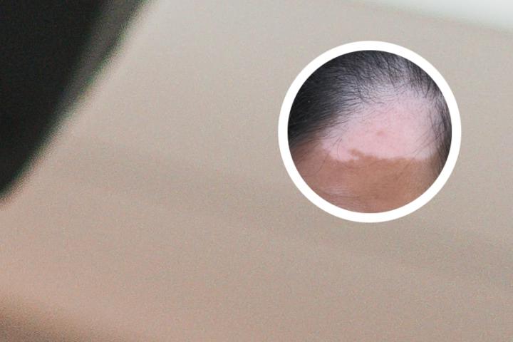 12岁男生身上有白癜风