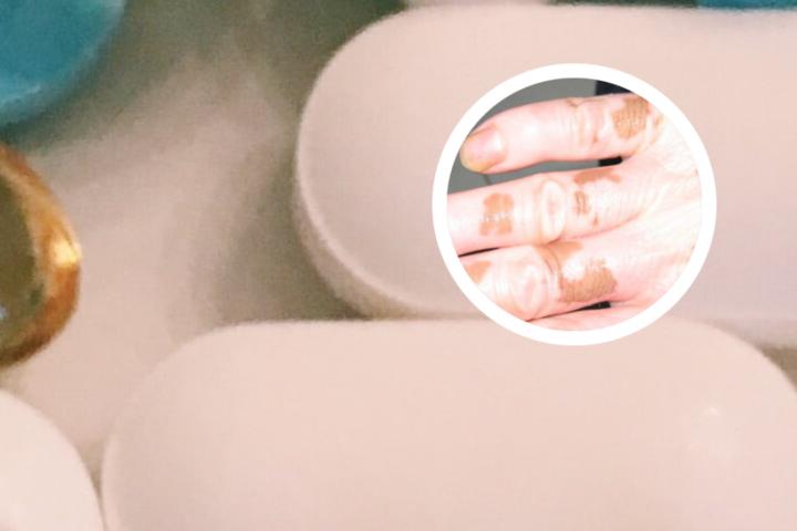 爱尔宁能治白癜风