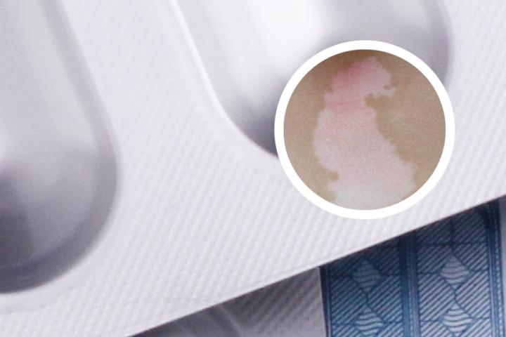 白癜风如何能治疗快