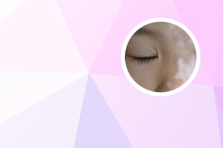 白癜风灯光效果图