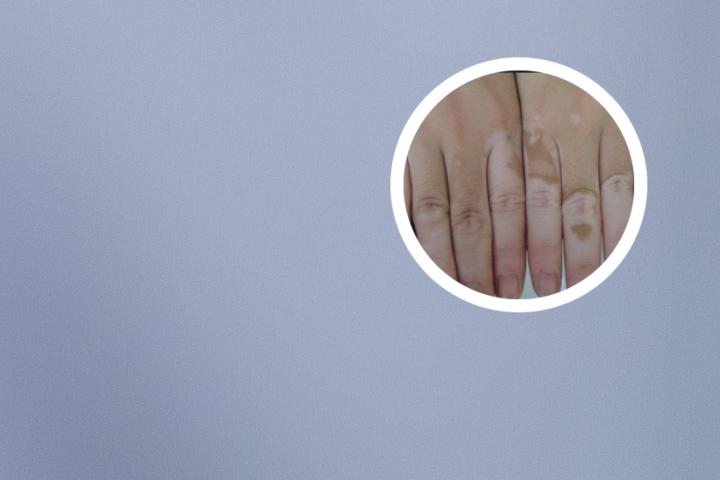 白癜风高考限制专业