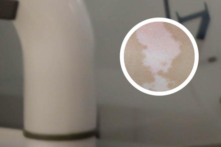 白癜风偶尔吃辣椒可以吗