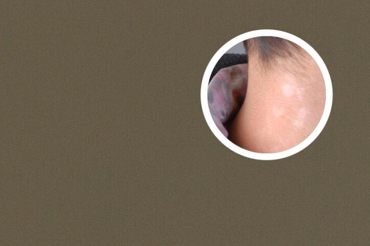 白癜风不长了还用吃药吗