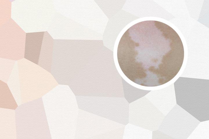 白癜风的敏感测试