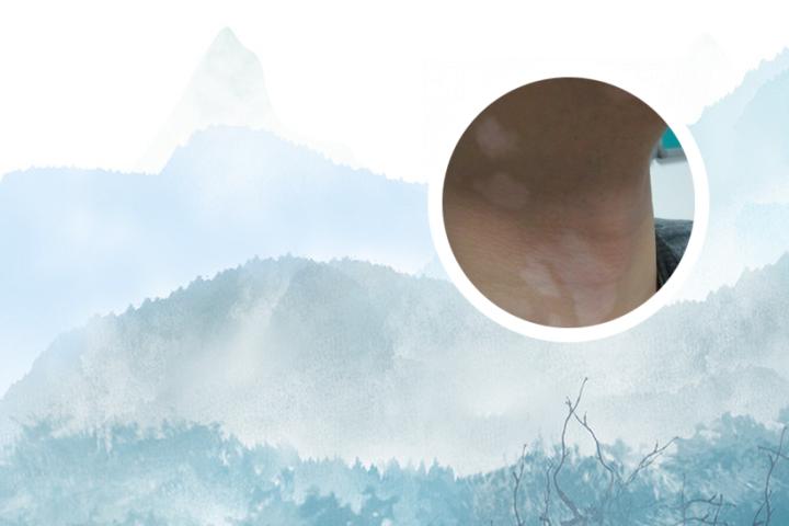 白癜风能遇到真爱吗