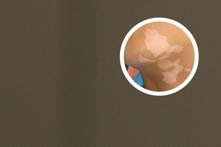 白癜风的女人视频