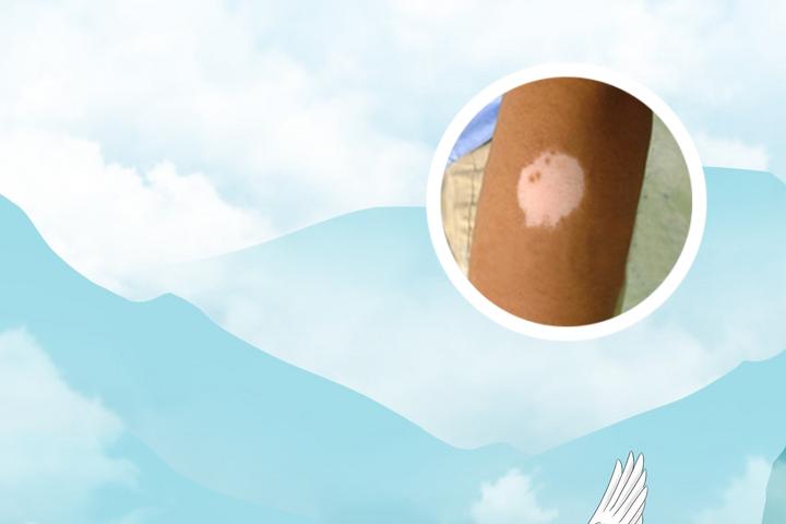 白癜风多大体现遗传性