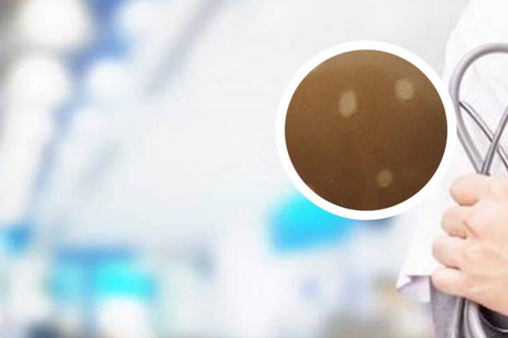 白癜风控制后如何不复发
