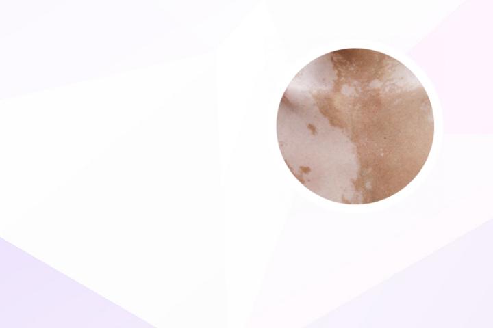 白癜风上面会有红色疙瘩很痒