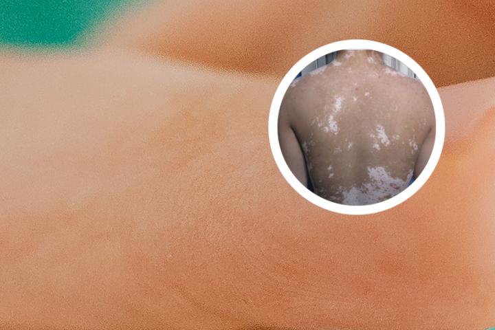 白癜风患者可以涂护肤品吗