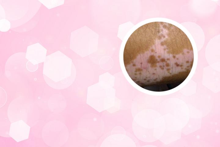白癜风查血常规查的出来不