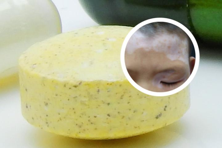 ddb白癜风蜕变