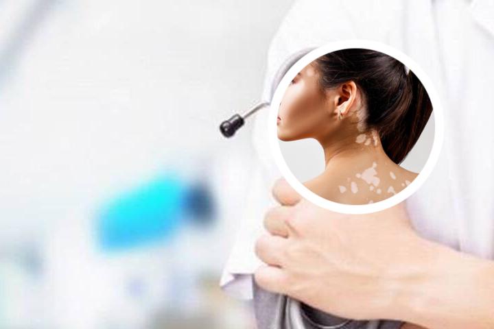 白癜风患者如何进行自我保健