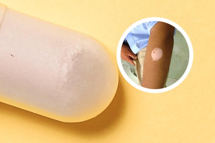 白癜风可以全身变白吗