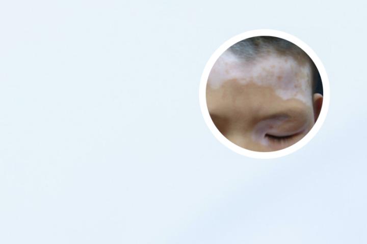 白癜风的护理要注意什么