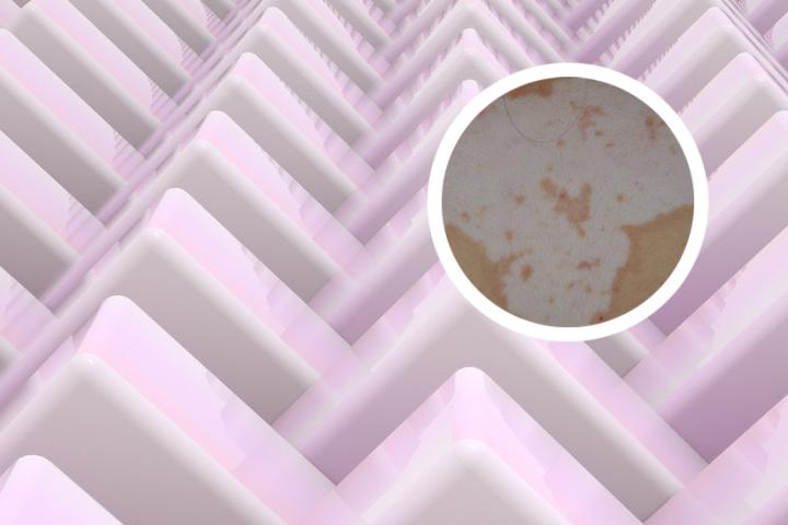 白癜风自愈10大方法