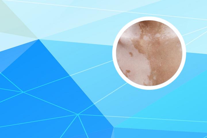 白癜风能吃干炒榛子吗