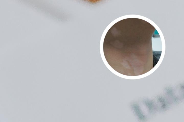 白癜风可以抹姜吗