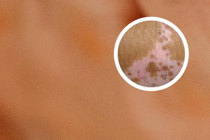 白癜风能用按摩仪吗