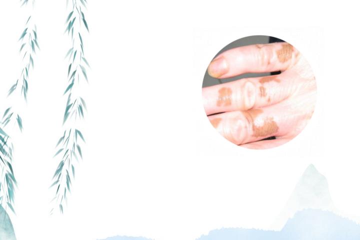 白癜风可以每天喝黑咖啡吗